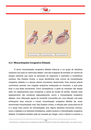 Coração normal          Coração hipertrofiado         Coração dilatado




4.2.1 Miocardiopatia Congestiva Dilatada


         O termo miocardiopatia congestiva dilatada refere-se a um grupo de distúrbios
cardíacos nos quais os ventrículos dilatam, mas são incapazes de bombear um volume de
sangue suficiente que supra as demandas do organismo e acarretam a insuficiência
cardíaca. Nos Estados Unidos, a causa identificável mais comum da miocardiopatia
congestiva dilatada é a doença arterial coronariana disseminada. Essa doença arterial
coronariana acarreta uma irrigação sangüínea inadequada ao miocárdio, a qual pode
levar a uma lesão permanente. Como conseqüência, a parte do miocárdio não lesada
sofre um espessamento para compensar a perda da função de bomba. Quando esse
espessamento não compensa adequadamente, ocorre a miocardiopatia congestiva
dilatada. Uma inflamação aguda do miocárdio (miocardite) por uma infecção viral pode
enfraquecer esse músculo e causar miocardiopatia congestiva dilatada (às vezes
denominada miocardiopatia viral). Nos Estados Unidos, a infecção pelo coxsa-ckievírus B
é a causa mais comum de miocardiopatia viral. Alguns distúrbios hormonais crônicos,
como o diabetes e os distúrbios tireoideanos, podem produzir a miocardiopatia congestiva
dilatada. O problema também pode ser causado por drogas, como o álcool e a cocaína, e


                                                                     126
Este material deve ser utilizado apenas como parâmetro de estudo deste Programa. Os créditos deste conteúdo são dados a seus respectivos autores
 