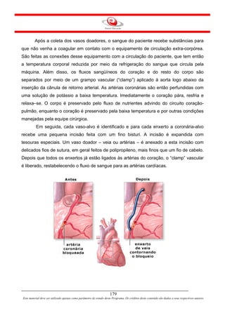 Após a coleta dos vasos doadores, o sangue do paciente recebe substâncias para
que não venha a coagular em contato com o equipamento de circulação extra-corpórea.
São feitas as conexões desse equipamento com a circulação do paciente, que tem então
a temperatura corporal reduzida por meio da refrigeração do sangue que circula pela
máquina. Além disso, os fluxos sangüíneos do coração e do resto do corpo são
separados por meio de um grampo vascular (“clamp”) aplicado à aorta logo abaixo da
inserção da cânula de retorno arterial. As artérias coronárias são então perfundidas com
uma solução de potássio a baixa temperatura. Imediatamente o coração pára, resfria e
relaxa–se. O corpo é preservado pelo fluxo de nutrientes advindo do circuito coração-
pulmão, enquanto o coração é preservado pela baixa temperatura e por outras condições
manejadas pela equipe cirúrgica.
          Em seguida, cada vaso-alvo é identificado e para cada enxerto a coronária-alvo
recebe uma pequena incisão feita com um fino bisturi. A incisão é expandida com
tesouras especiais. Um vaso doador – veia ou artérias – é anexado a esta incisão com
delicados fios de sutura, em geral feitos de polipropileno, mais finos que um fio de cabelo.
Depois que todos os enxertos já estão ligados às artérias do coração, o “clamp” vascular
é liberado, restabelecendo o fluxo de sangue para as artérias cardíacas.




                                                                     179
Este material deve ser utilizado apenas como parâmetro de estudo deste Programa. Os créditos deste conteúdo são dados a seus respectivos autores
 
