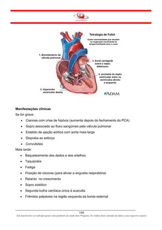 Manifestações clínicas
Se for grave:
    •     Cianose com crise de hipóxia (aumenta depois do fechamento do PCA)
    •     Sopro associado ao fluxo sangüíneo pela válvula pulmonar
    •     Estalido de ejeção aórtica com aorta mais larga
    •     Dispnéia ao esforço
    •     Convulsões
Mais tarde:
    •    Baqueteamento dos dedos e dos artelhos
    •    Taquipnéia
    •    Fadiga
    •    Posição de cócoras (para aliviar a angustia respiratória)
    •    Retardo no crescimento
    •    Sopro sistólico
    •    Segunda bulha cardíaca única à ausculta
    •    Frêmitos palpáveis na região esquerda da borda esternal



                                                                     160
Este material deve ser utilizado apenas como parâmetro de estudo deste Programa. Os créditos deste conteúdo são dados a seus respectivos autores
 
