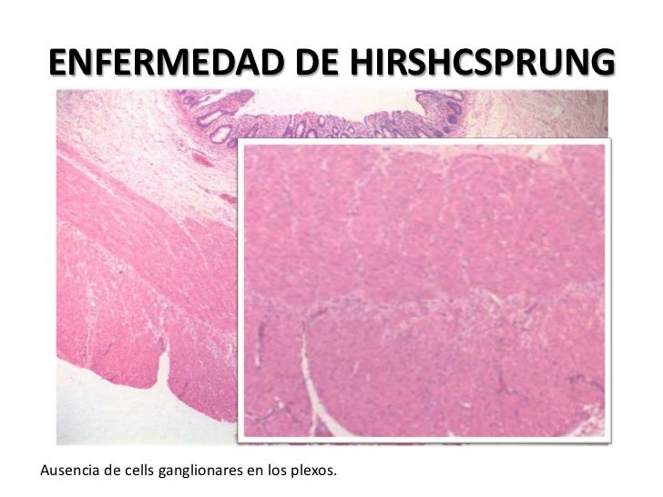 Enfermedad de hirschsprung