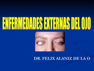 ENFERMEDADES EXTERNAS DEL OJO DR. FELIX ALANIZ DE LA O 