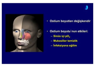 • Ostium boyutlar de4i(kendir
• Ostium boyutu`nun etkileri:
– Sinüs içi pO2
– Mukosilier temizlik
– :nfeksiyona e4ilim
•• OOstistiumum boyutlarboyutlar dede44ii((kendirkendir
•• OstiumOstium boyutu`nunboyutu`nun etkilerietkileri::
–– SinSinüüss iiççii pOpO22
–– MukosilierMukosilier temizliktemizlik
–– ::nfeksiyonanfeksiyona ee44ilimilim
 