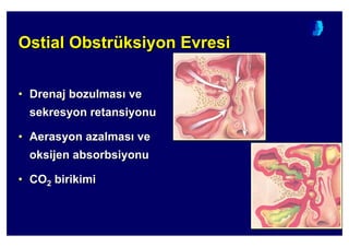 Ostial Obstrüksiyon EvresiOstialOstial ObstrObstrüüksiyonksiyon EvresiEvresi
•• DDrenajrenaj bozulmasbozulmas veve
sekresyonsekresyon retansiyonuretansiyonu
•• AerasyonAerasyon azalmasazalmas veve
oksijenoksijen absorbsiyonuabsorbsiyonu
•• COCO22 birikimibirikimi
 