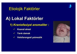Etiolojik FaktörlerEtiolojik FaktEtiolojik Faktöörlerrler
A) Lokal Faktörler
1) Kraniofasiyal anomaliler :
Koanal atrezi
Yar k damak
Velofarengeal yetmezlik
A)A) Lokal FaktLokal Faktöörlerrler
1)1) KraniofasiyalKraniofasiyal anomaliler :anomaliler :
KoanalKoanal atreziatrezi
YarYar k damakk damak
VelofarengealVelofarengeal yetmezlikyetmezlik
 