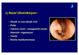 2) Nazal Obstrüksiyon :
– Alerjik ve non-alerjik rinit
– Polip
– Yabanc cisim - nazogastrik sonda
– Adenoid vegetasyon
– Tümör
– Rinitis medikamentoza
2)2) Nazal ObstrNazal Obstrüüksiyonksiyon ::
–– Alerjik veAlerjik ve nonnon--alerjikalerjik rinitrinit
–– PolipPolip
–– YabancYabanc cisimcisim -- nazogastriknazogastrik sondasonda
–– AdenoidAdenoid vegetasyonvegetasyon
–– TTüümmöörr
–– RinitisRinitis medikamentozamedikamentoza
 