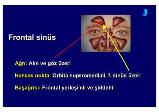 Frontal sinüsFrontalFrontal sinsinüüss
A4r : Al n ve göz üzeri
Hassas nokta: Orbita superomediali, f. sinüs üzeri
Ba(a4r s : Frontal yerle(imli ve (iddetli
AA44rr :: AlAl nn veve ggöözz üüzerizeri
HassasHassas noktanokta:: Orbita superomedialOrbita superomedialii, f, f.. sinsinüüss üüzerizeri
BaBa((aa44rr ss :: FrontalFrontal yerleyerle((imliimli veve ((iddetliiddetli
 