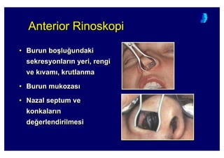 Anterior RinoskopiAnteriorAnterior RinoskopiRinoskopi
• Burun bo(lu4undaki
sekresyonlar n yeri, rengi
ve k vam , krutlanma
• Burun mukozas
• Nazal septum ve
konkalar n
de4erlendirilmesi
•• Burun boBurun bo((lulu44undakiundaki
sekresyonlarsekresyonlar nn yeri, rengiyeri, rengi
ve kve k vamvam ,, krutlanmakrutlanma
•• Burun mukozasBurun mukozas
•• NazalNazal septumseptum veve
konkalarkonkalar nn
dede44erlendirilmesierlendirilmesi
 