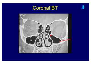 Coronal BTCoronalCoronal BTBT
 