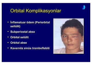 Orbital KomplikasyonlarOrbitalOrbital KomplikasyonKomplikasyonlarlar
• :nflamatuar ödem (Periorbital
sellülit)
• Subperiostal abse
• Orbital selülit
• Orbital abse
• Kavernöz sinüs tromboflebiti
•• ::nflamatuarnflamatuar öödemdem (Periorbital(Periorbital
sellsellüülitlit))
•• SubperiostalSubperiostal abseabse
•• OrbitalOrbital selselüülitlit
•• OrbitalOrbital abseabse
•• KavernKavernöözz sinsinüüss tromboflebititromboflebiti
 