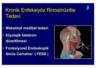 Kronik Enfeksiyöz Rinosinüzitte
Tedavi
Kronik EnfeksiyKronik Enfeksiyööz Rinosinz Rinosinüüzittezitte
TedaviTedavi
• Maksimal medikal tedavi
• Etyolojik faktörün
düzeltilmesi
• Fonksiyonel Endoskopik
Sinüs Cerrahisi ( FESS )
•• Maksimal mMaksimal medikaledikal tedavitedavi
•• EtyolojikEtyolojik faktfaktöörrüünn
ddüüzeltzeltilmesiilmesi
•• FonksiyonelFonksiyonel EndoskopikEndoskopik
SinSinüüss CerrahisiCerrahisi ( FESS )( FESS )
 