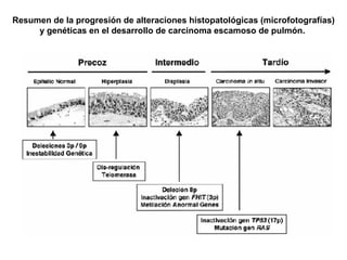 Resumen de la progresión de alteraciones histopatológicas (microfotografías)
y genéticas en el desarrollo de carcinoma escamoso de pulmón.
 