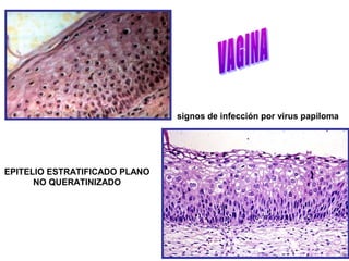 signos de infección por virus papiloma
EPITELIO ESTRATIFICADO PLANO
NO QUERATINIZADO
 