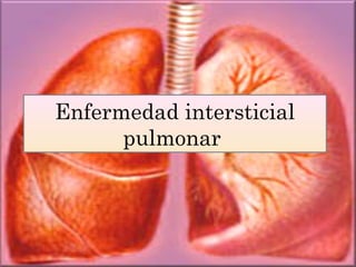 Enfermedad intersticial
      pulmonar
 