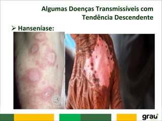 Algumas Doenças Transmissíveis com
Tendência Descendente
⮚Hanseníase:
– É uma doença infecciosa crônica causada pelo
Mycobacterium leprae.
– A preferência por nervos periféricos confere
características peculiares à bactéria, tornando o
seu diagnóstico simples.
– A hanseníase tem apresentado uma redução
significativa de sua prevalência, de 16,4 por 10.000
habitantes em 1985 para 4,52 por 10.000
habitantes em 2003.
 