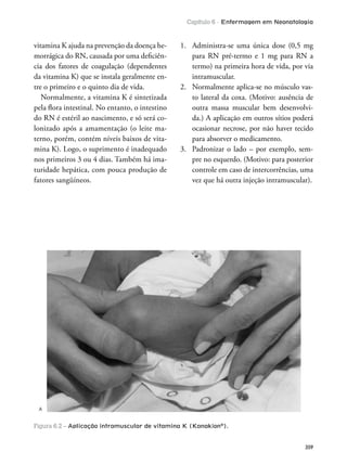 Capítulo 6 - Enfermagem em Neonatologia
359
vitamina K ajuda na prevenção da doença he-
morrágica do RN, causada por uma deiciên-
cia dos fatores de coagulação (dependentes
da vitamina K) que se instala geralmente en-
tre o primeiro e o quinto dia de vida.
Normalmente, a vitamina K é sintetizada
pela lora intestinal. No entanto, o intestino
do RN é estéril ao nascimento, e só será co-
lonizado após a amamentação (o leite ma-
terno, porém, contém níveis baixos de vita-
mina K). Logo, o suprimento é inadequado
nos primeiros 3 ou 4 dias. Também há ima-
turidade hepática, com pouca produção de
fatores sangüíneos.
1. Administra-se uma única dose (0,5 mg
para RN pré-termo e 1 mg para RN a
termo) na primeira hora de vida, por via
intramuscular.
2. Normalmente aplica-se no músculo vas-
to lateral da coxa. (Motivo: ausência de
outra massa muscular bem desenvolvi-
da.) A aplicação em outros sítios poderá
ocasionar necrose, por não haver tecido
para absorver o medicamento.
3. Padronizar o lado – por exemplo, sem-
pre no esquerdo. (Motivo: para posterior
controle em caso de intercorrências, uma
vez que há outra injeção intramuscular).
Figura 6.2 – Aplicação intramuscular de vitamina K (Kanakion®
).
A
 