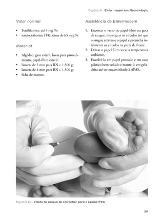 Capítulo 6 - Enfermagem em Neonatologia
387
Figura 6.14 – Coleta do sangue do calcanhar para o exame PKU.
Valor normal
Material
-
mento, papel-iltro estéril;
Assistência de Enfermagem
1. Encostar o verso do papel-iltro na gota
de sangue, impregnar os círculos até que
o sangue atravesse o papel e preencha to-
talmente os círculos na parte da frente.
2. Deixar o papel iltro secar à temperatura
ambiente.
3. Envolvê-lo em papel prateado e em saco
plástico bem vedado e mantê-lo em gela-
deira até ser encaminhado à APAE.
 