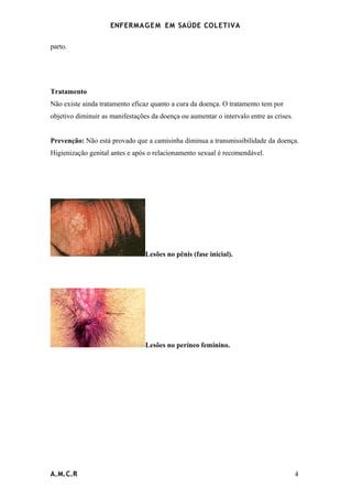 ENFERMAG E M EM SAÚDE COLETIVA

parto.




Tratamento
Não existe ainda tratamento eficaz quanto a cura da doença. O tratamento tem por
objetivo diminuir as manifestações da doença ou aumentar o intervalo entre as crises.


Prevenção: Não está provado que a camisinha diminua a transmissibilidade da doença.
Higienização genital antes e após o relacionamento sexual é recomendável.




                                 Lesões no pênis (fase inicial).




                                 Lesões no períneo feminino.




A.M.C.R                                                                                 4
 