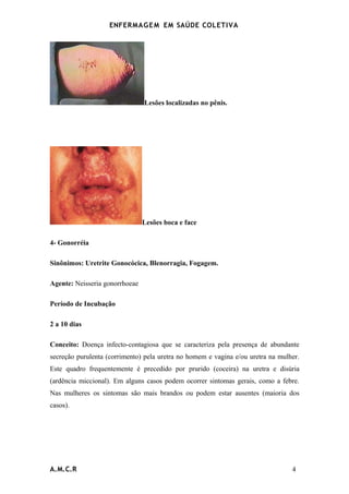 ENFERMAG E M EM SAÚDE COLETIVA




                                Lesões localizadas no pênis.




                                Lesões boca e face

4- Gonorréia

Sinônimos: Uretrite Gonocócica, Blenorragia, Fogagem.

Agente: Neisseria gonorrhoeae

Período de Incubação

2 a 10 dias

Conceito: Doença infecto-contagiosa que se caracteriza pela presença de abundante
secreção purulenta (corrimento) pela uretra no homem e vagina e/ou uretra na mulher.
Este quadro frequentemente é precedido por prurido (coceira) na uretra e disúria
(ardência miccional). Em alguns casos podem ocorrer sintomas gerais, como a febre.
Nas mulheres os sintomas são mais brandos ou podem estar ausentes (maioria dos
casos).




A.M.C.R                                                                          4
 