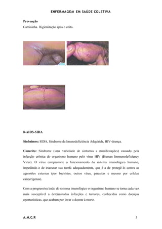 ENFERMAG E M EM SAÚDE COLETIVA

Prevenção
Camisinha. Higienização após o coito.




                               .




8-AIDS-SIDA

Sinônimos: SIDA, Síndrome da Imunodeficiência Adquirida, HIV-doença.

Conceito: Síndrome (uma variedade de sintomas e manifestações) causado pela
infecção crônica do organismo humano pelo vírus HIV (Human Immunodeficiency
Virus). O vírus compromete o funcionamento do sistema imunológico humano,
impedindo-o de executar sua tarefa adequadamente, que é a de protegê-lo contra as
agressões externas (por bactérias, outros vírus, parasitas e mesmo por celulas
cancerígenas).

Com a progressiva lesão do sistema imunológico o organismo humano se torna cada vez
mais susceptível a determinadas infecções e tumores, conhecidas como doenças
oportunísticas, que acabam por levar o doente à morte.




A.M.C.R                                                                         5
 