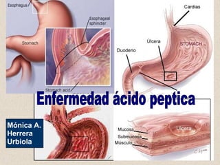 Enfermedad ácido peptica Mónica A. Herrera Urbiola 