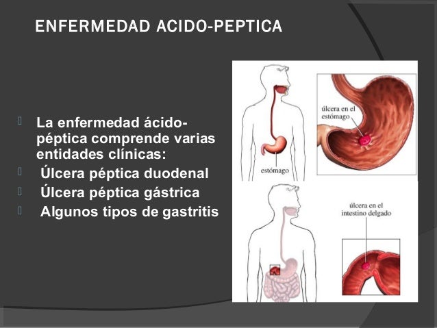 ENFERMEDAD ACIDO PEPTICA