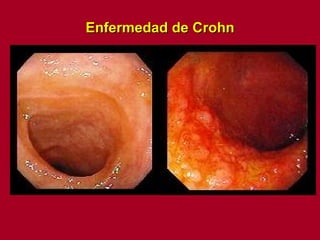 Enfermedad de Crohn 