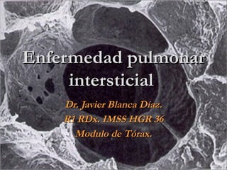 Enfermedad pulmonarEnfermedad pulmonar
intersticialintersticial
Dr. Javier Blanca Díaz.Dr. Javier Blanca Díaz.
R1 RDx. IMSS HGR 36R1 RDx. IMSS HGR 36
Modulo de Tórax.Modulo de Tórax.
 