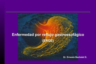 Enfermedad por reflujo gastroesofágico (ERGE) Dr. Ernesto Bachelet D. 