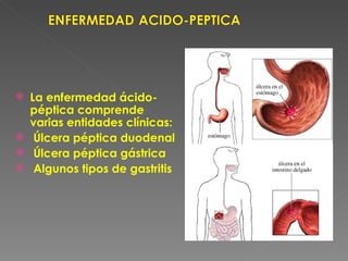    La enfermedad ácido-
    péptica comprende
    varias entidades clínicas:
    Úlcera péptica duodenal
    Úlcera péptica gástrica
    Algunos tipos de gastritis
 