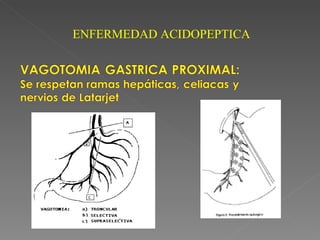 ENFERMEDAD ACIDOPEPTICA
 