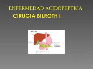 ENFERMEDAD ACIDOPEPTICA
 
