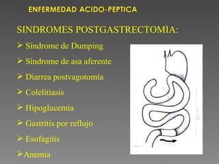 SINDROMES POSTGASTRECTOMIA:
 Síndrome de Dumping
 Síndrome de asa aferente
 Diarrea postvagotomía
 Colelitiasis
 Hipoglucemia
 Gastritis por reflujo
 Esofagitis
Anemia
 