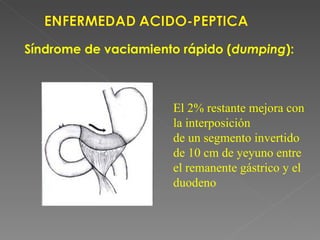 Síndrome de vaciamiento rápido (dumping):



                      El 2% restante mejora con
                      la interposición
                      de un segmento invertido
                      de 10 cm de yeyuno entre
                      el remanente gástrico y el
                      duodeno
 