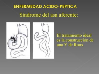 Síndrome del asa aferente:


                El tratamiento ideal
                es la construcción de
                una Y de Roux
 