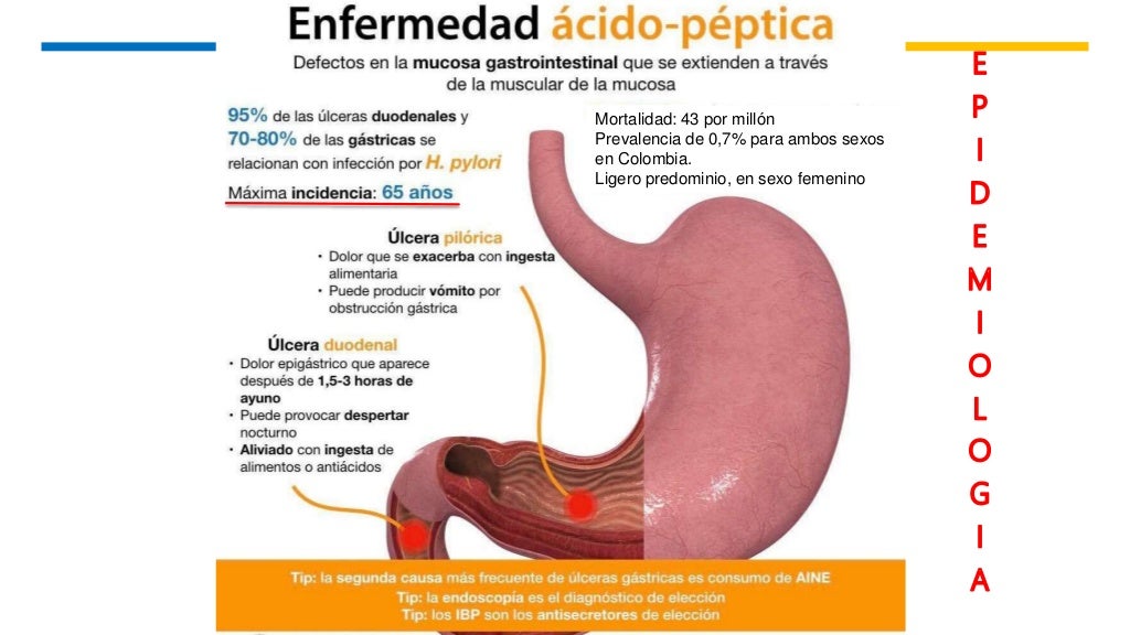 Enfermedad acido peptica