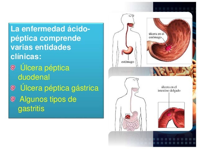 Enfermedad acido peptica