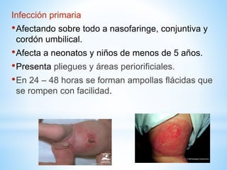 Infección primaria
•Afectando sobre todo a nasofaringe, conjuntiva y
cordón umbilical.
•Afecta a neonatos y niños de menos de 5 años.
•Presenta pliegues y áreas periorificiales.
•En 24 – 48 horas se forman ampollas flácidas que
se rompen con facilidad.
 