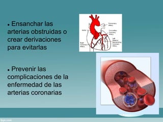  Ensanchar las 
arterias obstruidas o 
crear derivaciones 
para evitarlas 
 Prevenir las 
complicaciones de la 
enfermedad de las 
arterias coronarias 
 