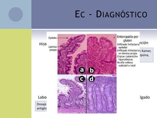 E C - D IAGNÓSTICO

 Historia clínica                             Laboratorio de Absorción
                           Determinar cantidad de grasas en MF (Van de Kamer,
                           esteatocrito, Sudán IV, clearence de α1anti tripsina,
                           dosaje de IgA antigliadina)




Laboratorio de Anticuerpos                 Biopsia de intestino delgado
Dosaje de IgA e IgG EmA, anti tTG y
antigliadina
 