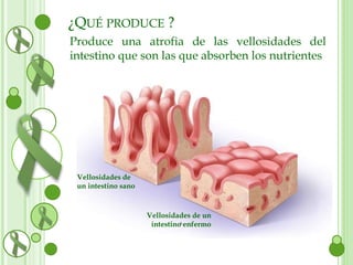 ¿QUÉ PRODUCE ? 
Produce una atrofia de las vellosidades del 
intestino que son las que absorben los nutrientes 
Vellosidades de 
un intestino sano 
Vellosidades de un 
intestino enfermo 
 
