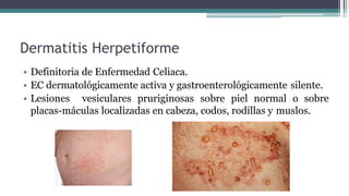 Dermatitis Herpetiforme
• Definitoria de Enfermedad Celiaca.
• EC dermatológicamente activa y gastroenterológicamente silente.
• Lesiones vesiculares pruriginosas sobre piel normal o sobre
placas-máculas localizadas en cabeza, codos, rodillas y muslos.
 