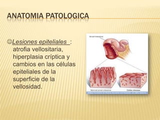 ANATOMIA PATOLOGICA


Lesiones epiteliales :
 atrofia vellositaria,
 hiperplasia críptica y
 cambios en las células
 epiteliales de la
 superficie de la
 vellosidad.
 
