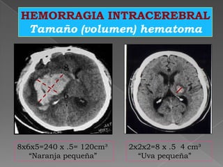 HEMORRAGIA INTRACEREBRAL
 Tamaño (volumen) hematoma


           8


           6




8x6x5=240 x .5= 120cm³   2x2x2=8 x .5 4 cm³
   “Naranja pequeña”       “Uva pequeña”
 