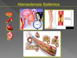 Aterosclerosis Sistémica
 