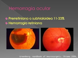  Prerretiniana o subhialoidea 11-33%
 Hemorragia retiniana




        Greenberg. Handbook of Neurosurgery. Thieme 2006.
 