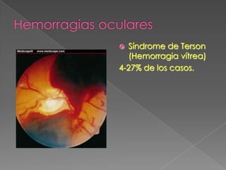  Síndrome de Terson
  (Hemorragia vítrea)
4-27% de los casos.
 