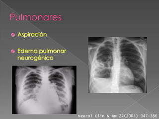    Aspiración

   Edema pulmonar
    neurogénico




                     Neurol Clin N Am 22(2004) 347-366
 