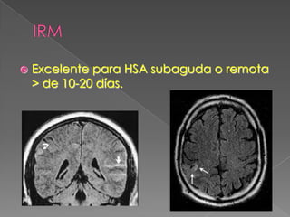   Excelente para HSA subaguda o remota
    > de 10-20 días.
 