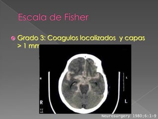    Grado 3: Coagulos localizados y capas
    > 1 mm.




                            Neurosurgery 1980;6:1-9
 