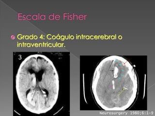    Grado 4: Coágulo intracerebral o
    intraventricular.




                             Neurosurgery 1980;6:1-9
 